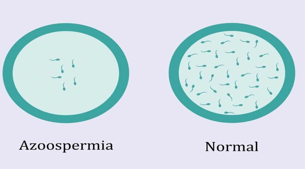 Azoospermia - nil Sperm Count Treatment