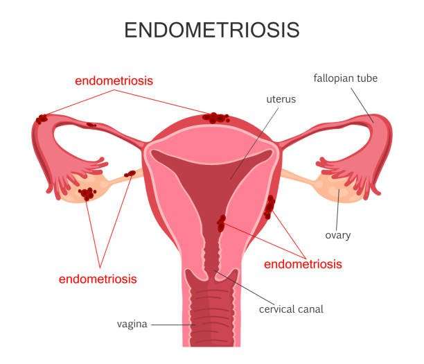Cure Endometriosis Without Surgery
