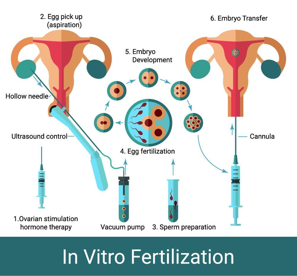 Step-By-Step IVF Process
