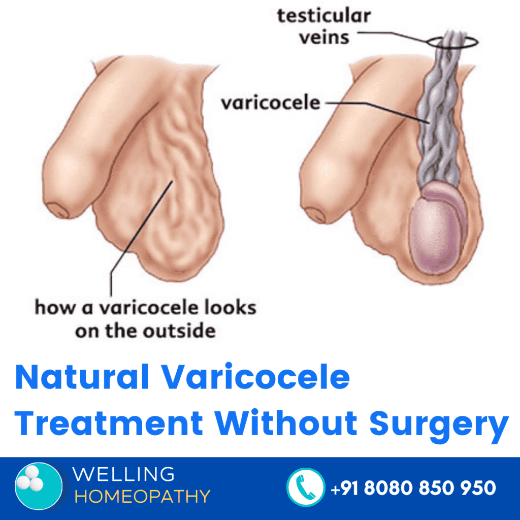 Natural Varicocele Treatment Without Surgery