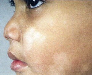 Treatment for white patches on face