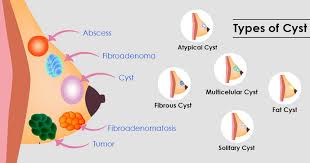 treatment of Fibroadenoma