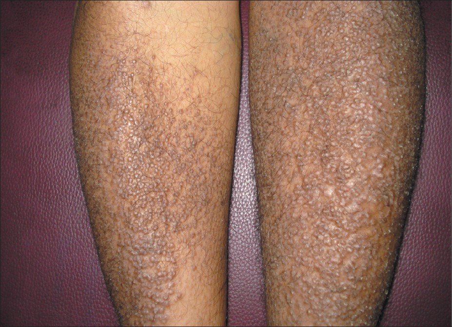 What is the best treatment for lichen planus?