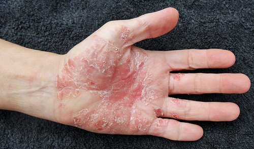 How To Cure Psoriasis Permanently?