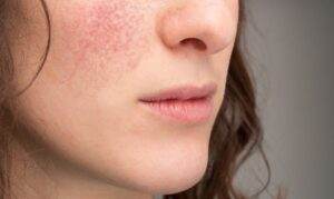 How to treat eczema on face?