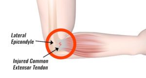 Homeopathy treatment of tennis elbow