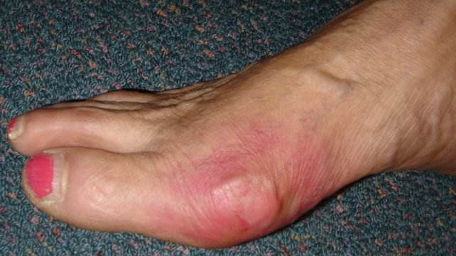 642x361_SLIDE_1_Gout_Symptoms
