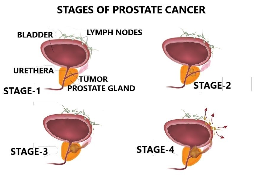 How many stages are there to prostate cancer