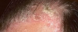 How to Treat Psoriasis Permanently in Surat? 4