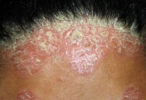How to Treat Psoriasis Permanently in Surat? 1