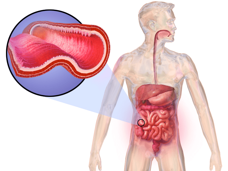 treatment of Crohn's Disease