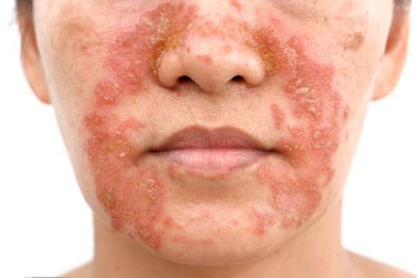 Eczema on Face