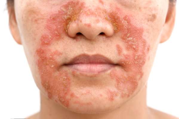 eczema face