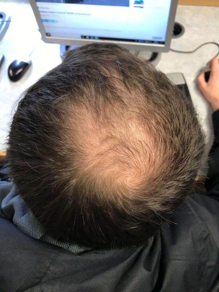 COVID-19 Cause hair loss