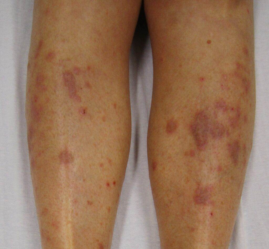 Homeopathy treatment for Lichen_Planus