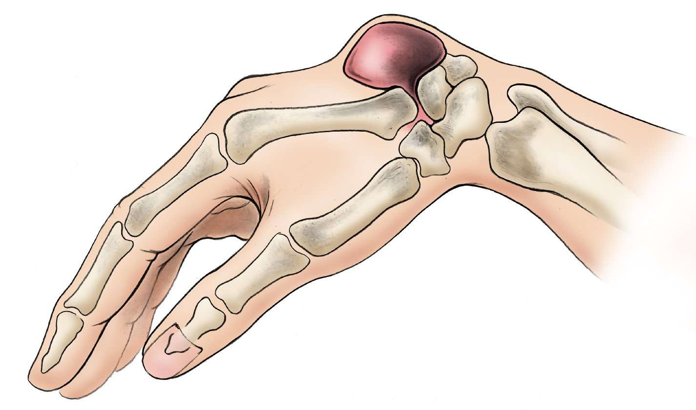 Болит основание сустава большого пальца. Гигрома лучезапястного сустава. Гигрома лучезапястного сустава руки. Синовиальная киста (гигрома).