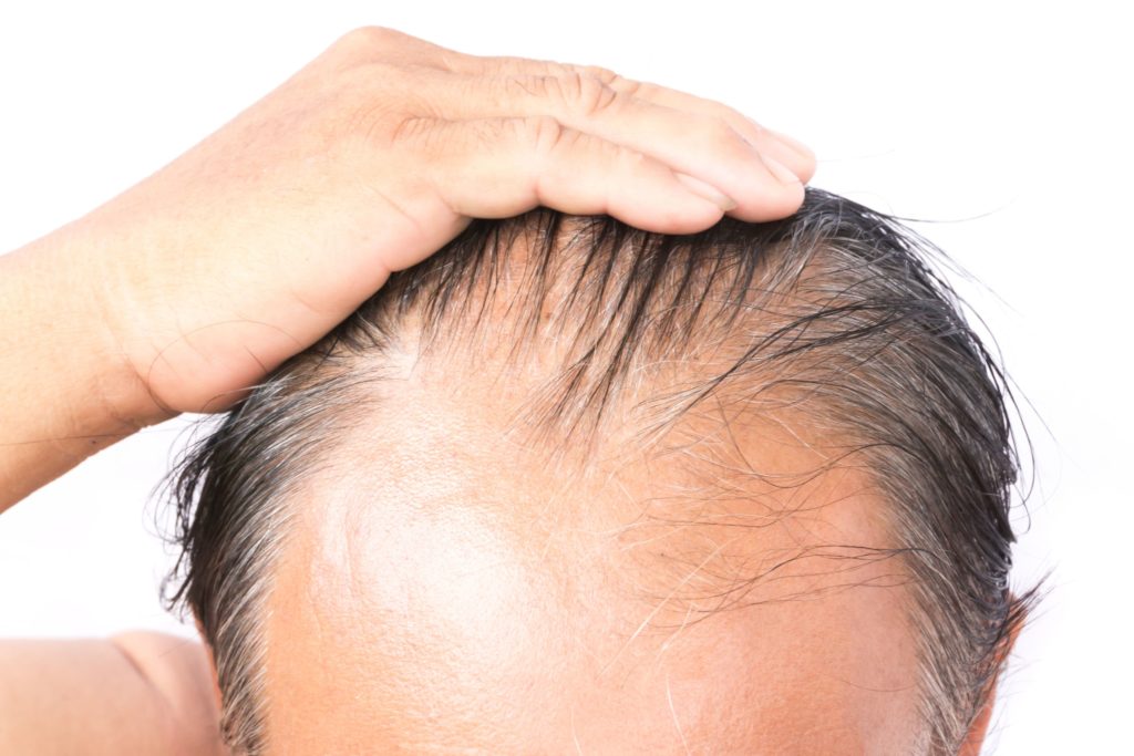 Homeopathy treatment for hair loss