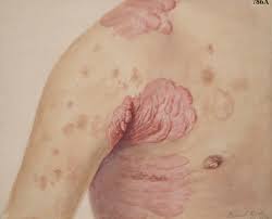 Treatment For Urticaria 1 Living With Urticaria