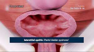 Treatment of Interstitial Cystitis