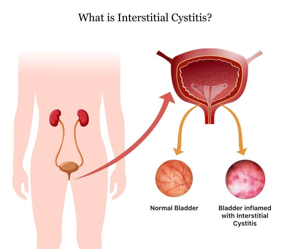Homeopathy medicines for Interstitial Cystitis