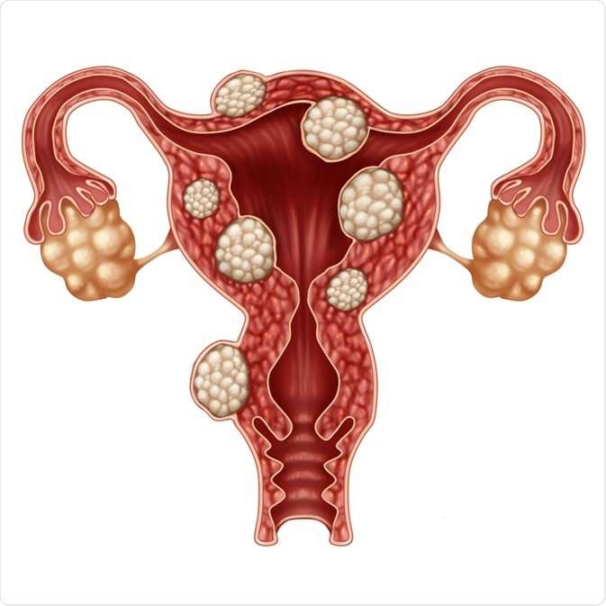 Homeopathy medicine for fibroids