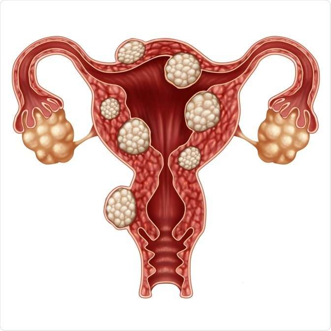 Treatment of Fibroids 2 Homeopathy medicine for fibroids