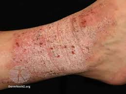 Natural Remedies For GERD