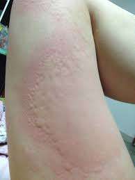 treatment for urticaria