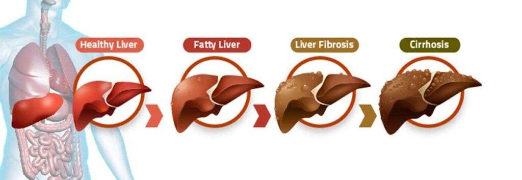 Homeopathy Treatment of Liver Cirrhosis 1 treatment of liver cirrhosis