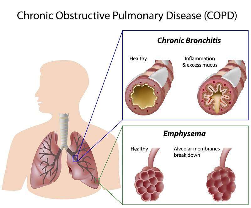 Treatment Of COPD