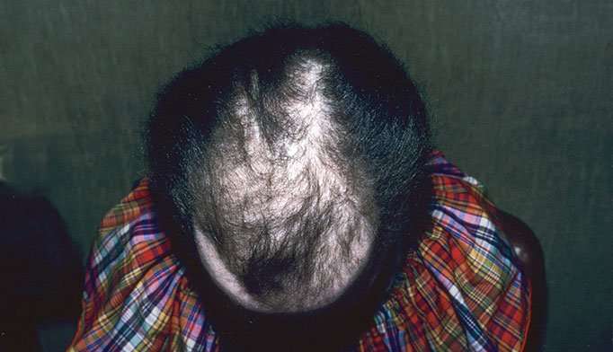 Hair Loss Causes In Women