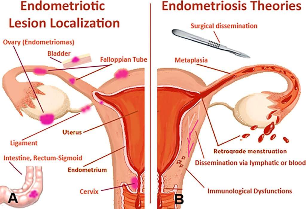 Homeopathy treatment of Endometriosis