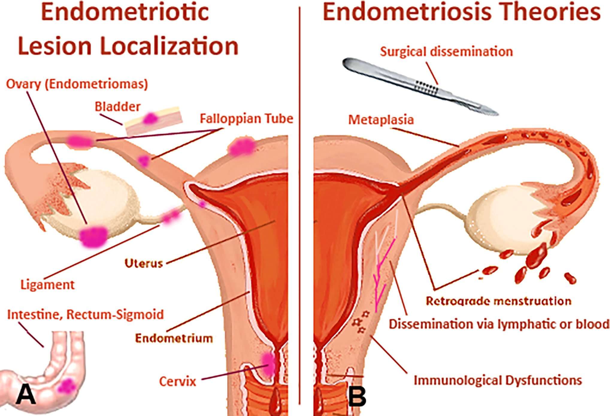 best-homeopathy-treatment-of-endometriosis-in-mumbai-surat