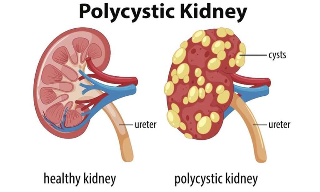 Homeopathy treatment of Polycystic Kidney Disease