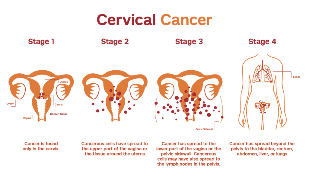 Treatment of cervical cancer