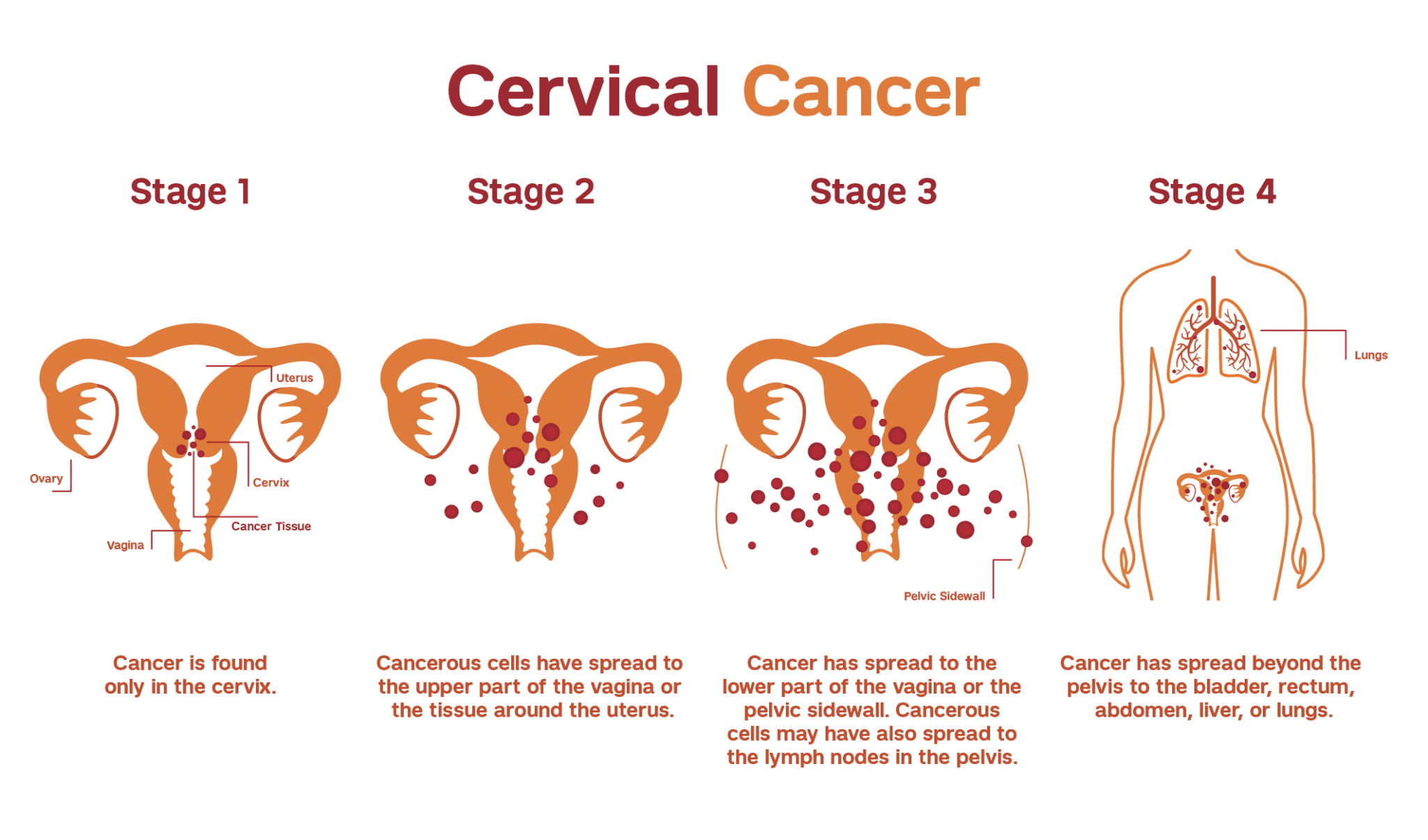 Treatment Of Cervical Cancer Best Homeopathy Doctor In India US UK Europe