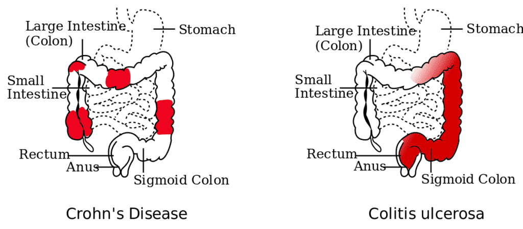 homeopathic medicines of crohn's disease