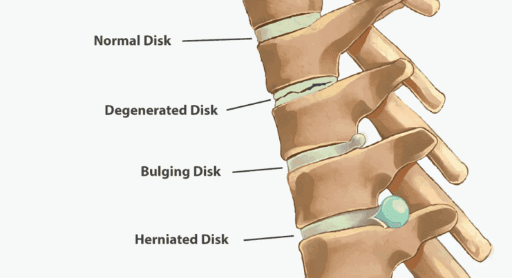 Homeopathy Treatment of Slipped Disc