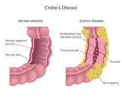 homeopathic treatment of crohn's disease