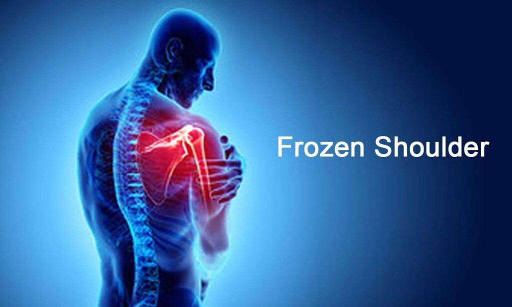 homeopathy treatment of Frozen Shoulder