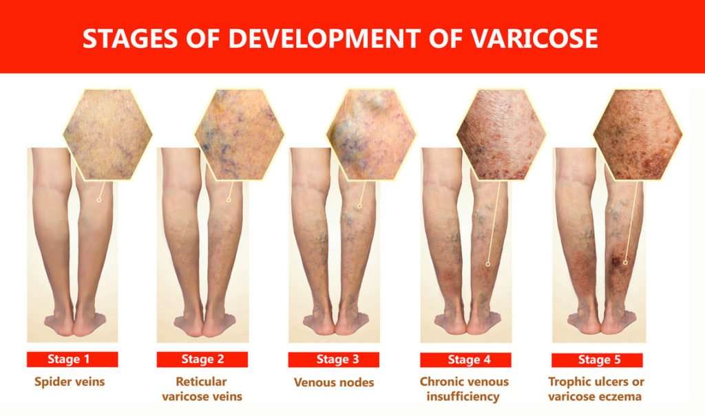 homeopthy treatment of Varicose Veins
