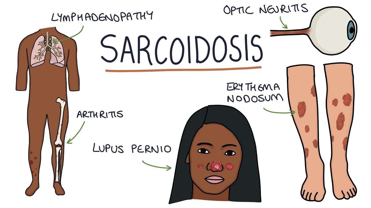 Sarcoidosis • Best Doctor For Homeopathy Treatment of Sarcoidosis in 2022
