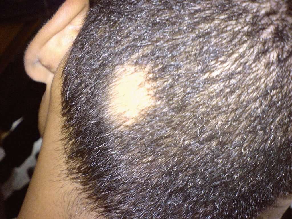 Best Treatment of Alopecia Areata in Mumbai, Surat,  Homeopathy