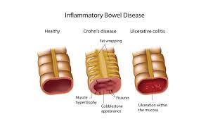 Treatment of Inflammatory bowel disease (IBD)