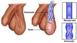 treatment of varicose veins on testicles