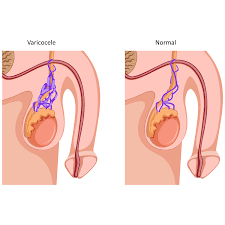 Treatment of Varicose Veins On Testicles