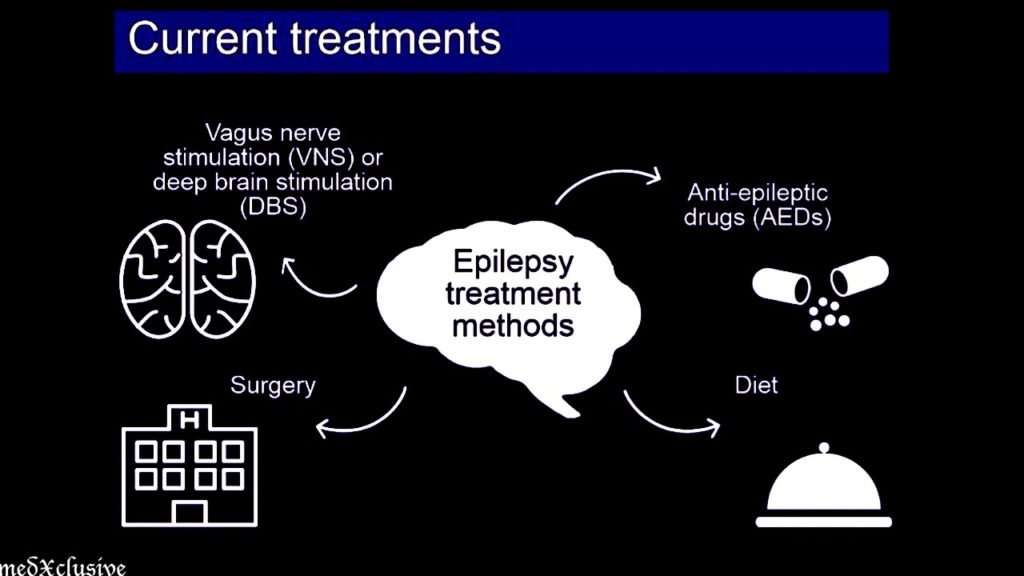 Treatment For Epilepsy
