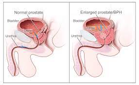Treatment of Prostate Enlargement