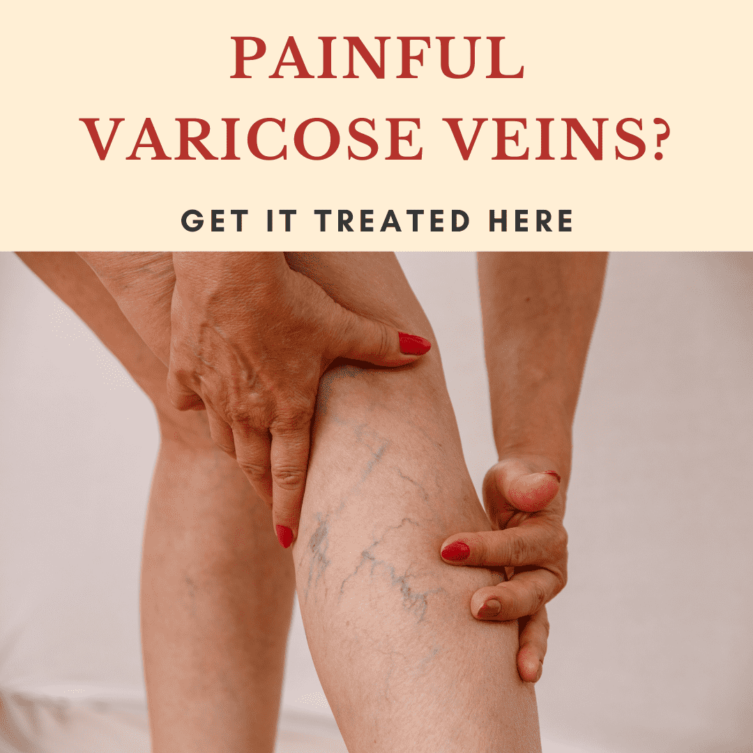 Painful Varicose Veins