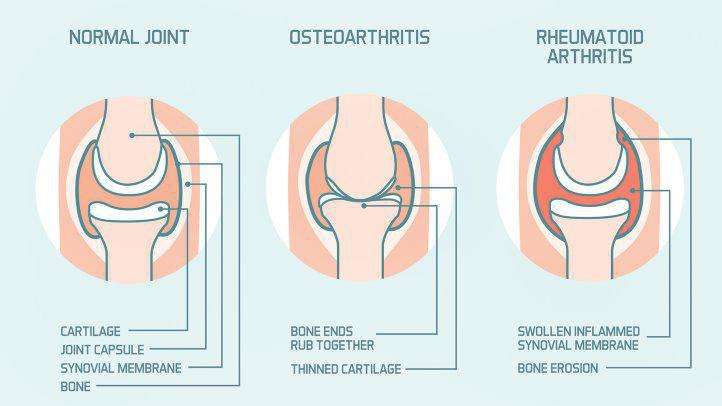 What Is The Difference Between Arthritis & Osteoarthritis?